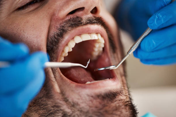 Best Emergency Wisdom Tooth Extraction in USA